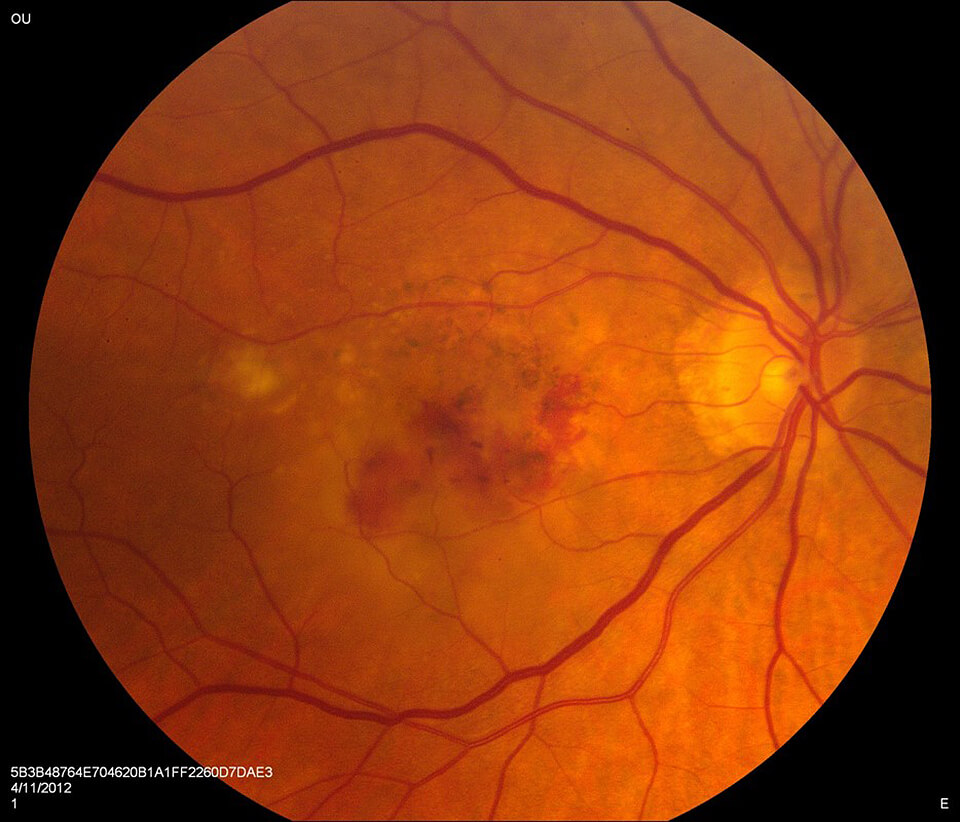 Age-Related Macular Degeneration (AMD)