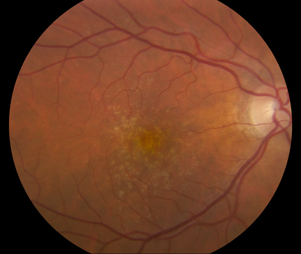 Age-Related Macular Degeneration (AMD)