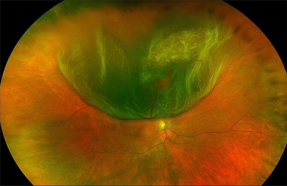 Retinal Tears & Detachments